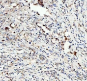 IHC staining of FFPE human rectum adenocarcinoma tissue with LEO1 antibody. HIER: boil tissue sections in pH8 EDTA for 20 min and allow to cool before testing.