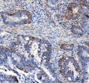 IHC staining of FFPE human colorectal adenocarcinoma tissue with LRRC59 antibody. HIER: boil tissue sections in pH8 EDTA for 20 min and allow to cool before testing.
