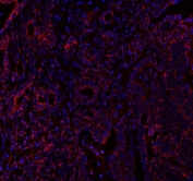Immunofluorescent staining of FFPE human intestinal cancer tissue with GbetaL antibody (red) and DAPI nuclear stain (blue). HIER: steam section in pH8 EDTA buffer for 20 min.