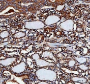 IHC staining of FFPE human thyroid papillary carcinoma tissue with GbetaL antibody. HIER: boil tissue sections in pH8 EDTA for 20 min and allow to cool before testing.