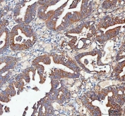 IHC staining of FFPE human rectum adenocarcinoma tissue with GbetaL antibody. HIER: boil tissue sections in pH8 EDTA for 20 min and allow to cool before testing.
