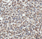 IHC staining of FFPE human liver cancer tissue with GbetaL antibody. HIER: boil tissue sections in pH8 EDTA for 20 min and allow to cool before testing.