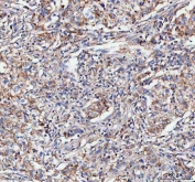 IHC staining of FFPE human lung cancer tissue with GbetaL antibody. HIER: boil tissue sections in pH8 EDTA for 20 min and allow to cool before testing.