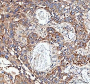 IHC staining of FFPE human esophageal squamous carcinoma tissue with GbetaL antibody. HIER: boil tissue sections in pH8 EDTA for 20 min and allow to cool before testing.