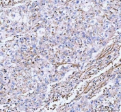 IHC staining of FFPE human lung cancer tissue with LSG1 antibody. HIER: boil tissue sections in pH8 EDTA for 20 min and allow to cool before testing.