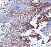 IHC staining of FFPE human esophageal squamous carcinoma tissue with LSG1 antibody. HIER: boil tissue sections in pH8 EDTA for 20 min and allow to cool before testing.