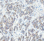 IHC staining of FFPE human lung adenocarcinoma tissue with Pellino 2 antibody. HIER: boil tissue sections in pH8 EDTA for 20 min and allow to cool before testing.