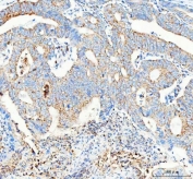 IHC staining of FFPE human colorectal adenocarcinoma tissue with Pellino 2 antibody. HIER: boil tissue sections in pH8 EDTA for 20 min and allow to cool before testing.