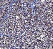 IHC staining of FFPE human adrenal adenoma tissue with LIN7C antibody. HIER: boil tissue sections in pH8 EDTA for 20 min and allow to cool before testing.