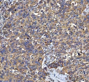 IHC staining of FFPE human bladder urothelial carcinoma tissue with LIN7C antibody. HIER: boil tissue sections in pH8 EDTA for 20 min and allow to cool before testing.