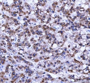 IHC staining of FFPE human liver cancer tissue with Ribosome binding protein 1 antibody. HIER: boil tissue sections in pH8 EDTA for 20 min and allow to cool before testing.