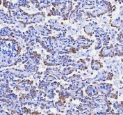 IHC staining of FFPE human lung cancer tissue with Ribosome binding protein 1 antibody. HIER: boil tissue sections in pH8 EDTA for 20 min and allow to cool before testing.