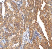 IHC staining of FFPE human thyroid papillary carcinoma tissue with EIF3B antibody. HIER: boil tissue sections in pH8 EDTA for 20 min and allow to cool before testing.