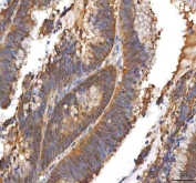IHC staining of FFPE human colon adenocarcinoma tissue with EIF3B antibody. HIER: boil tissue sections in pH8 EDTA for 20 min and allow to cool before testing.