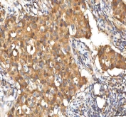 IHC staining of FFPE human breast cancer tissue with EIF3B antibody. HIER: boil tissue sections in pH8 EDTA for 20 min and allow to cool before testing.
