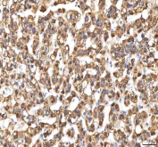 IHC staining of FFPE human liver cancer tissue with EIF3B antibody. HIER: boil tissue sections in pH8 EDTA for 20 min and allow to cool before testing.