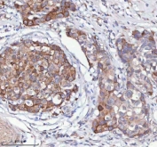 IHC staining of FFPE human breast cancer tissue with HAGH antibody. HIER: boil tissue sections in pH8 EDTA for 20 min and allow to cool before testing.