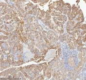 IHC staining of FFPE human thyroid papillary carcinoma tissue with HAGH antibody. HIER: boil tissue sections in pH8 EDTA for 20 min and allow to cool before testing.