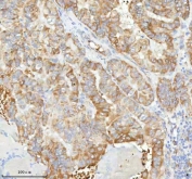 IHC staining of FFPE human thyroid papillary carcinoma tissue with HAGH antibody. HIER: boil tissue sections in pH8 EDTA for 20 min and allow to cool before testing.