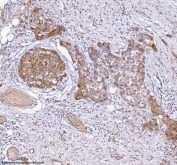 IHC staining of FFPE human breast cancer tissue with HAGH antibody. HIER: boil tissue sections in pH8 EDTA for 20 min and allow to cool before testing.