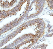 IHC staining of FFPE human colon adenocarcinoma tissue with HAGH antibody. HIER: boil tissue sections in pH8 EDTA for 20 min and allow to cool before testing.