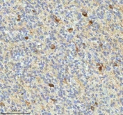 IHC staining of FFPE human glioblastoma tissue with HAGH antibody. HIER: boil tissue sections in pH8 EDTA for 20 min and allow to cool before testing.
