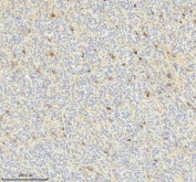 IHC staining of FFPE human glioblastoma tissue with HAGH antibody. HIER: boil tissue sections in pH8 EDTA for 20 min and allow to cool before testing.