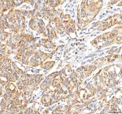 IHC staining of FFPE human urothelial carcinoma tissue with ITPA antibody. HIER: boil tissue sections in pH8 EDTA for 20 min and allow to cool before testing.