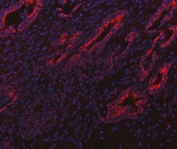 Immunofluorescent staining of FFPE human intestinal cancer tissue with ITPA antibody (red) and DAPI nuclear stain (blue). HIER: steam section in pH8 EDTA buffer for 20 min.