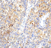 IHC staining of FFPE human liver cancer tissue with HEPACAM2 antibody. HIER: boil tissue sections in pH8 EDTA for 20 min and allow to cool before testing.