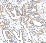 IHC staining of FFPE human thyroid papillary carcinoma tissue with OMI antibody. HIER: boil tissue sections in pH8 EDTA for 20 min and allow to cool before testing.