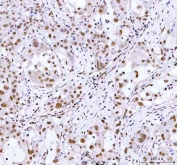 IHC staining of FFPE human lung cancer tissue with ARID domain-containing protein 1A antibody. HIER: boil tissue sections in pH8 EDTA for 20 min and allow to cool before testing.