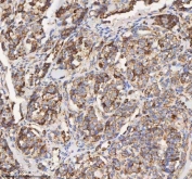 IHC staining of FFPE human lung adenocarcinoma tissue with HADH antibody. HIER: boil tissue sections in pH8 EDTA for 20 min and allow to cool before testing.