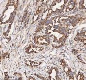 IHC staining of FFPE human pancreas ductal adenocarcinoma tissue with HADH antibody. HIER: boil tissue sections in pH8 EDTA for 20 min and allow to cool before testing.