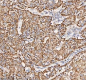 IHC staining of FFPE human urothelial carcinoma tissue with HADH antibody. HIER: boil tissue sections in pH8 EDTA for 20 min and allow to cool before testing.