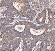 IHC staining of FFPE human colon adenocarcinoma tissue with HADH antibody. HIER: boil tissue sections in pH8 EDTA for 20 min and allow to cool before testing.