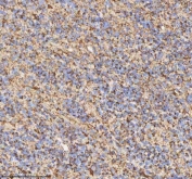 IHC staining of FFPE human glioblastoma tissue with HADH antibody. HIER: boil tissue sections in pH8 EDTA for 20 min and allow to cool before testing.