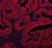 Immunofluorescent staining of FFPE human intestinal cancer tissue with HADH antibody (red) and DAPI nuclear stain (blue). HIER: steam section in pH8 EDTA buffer for 20 min.