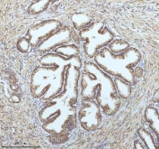 IHC staining of FFPE human prostate cancer tissue with PIN4 antibody. HIER: boil tissue sections in pH8 EDTA for 20 min and allow to cool before testing.
