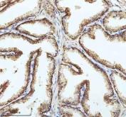 IHC staining of FFPE human prostate cancer tissue with PIN4 antibody. HIER: boil tissue sections in pH8 EDTA for 20 min and allow to cool before testing.