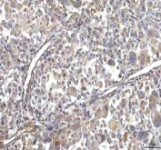 IHC staining of FFPE human lung cancer tissue with RASGRP3 antibody. HIER: boil tissue sections in pH8 EDTA for 20 min and allow to cool before testing.