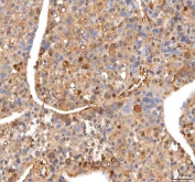 IHC staining of FFPE human liver cancer tissue with ISYNA1 antibody. HIER: boil tissue sections in pH8 EDTA for 20 min and allow to cool before testing.