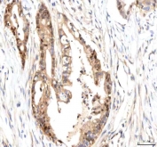 IHC staining of FFPE human pancreas ductal adenocarcinoma tissue with ISYNA1 antibody. HIER: boil tissue sections in pH8 EDTA for 20 min and allow to cool before testing.