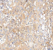 IHC staining of FFPE human urothelial carcinoma tissue with ISYNA1 antibody. HIER: boil tissue sections in pH8 EDTA for 20 min and allow to cool before testing.