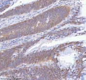 IHC staining of FFPE human colon adenocarcinoma tissue with METTL18 antibody. HIER: boil tissue sections in pH8 EDTA for 20 min and allow to cool before testing.