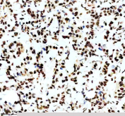 IHC staining of FFPE human breast cancer tissue with Phospho-MDM2 antibody, HRP-secondary and DAB substrate. HIER: boil tissue sections in pH8 EDTA for 20 min and allow to cool before testing.