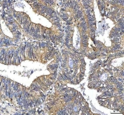 IHC staining of FFPE human endometrioid adenocarcinoma tissue with HTT antibody. HIER: boil tissue sections in pH8 EDTA for 20 min and allow to cool before testing.