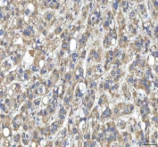 IHC staining of FFPE human liver cancer tissue with HTT antibody. HIER: boil tissue sections in pH8 EDTA for 20 min and allow to cool before testing.