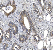 IHC staining of FFPE human colon adenocarcinoma tissue with HTT antibody. HIER: boil tissue sections in pH8 EDTA for 20 min and allow to cool before testing.