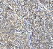 IHC staining of FFPE human cervix squamous cell carcinoma tissue with HTT antibody. HIER: boil tissue sections in pH8 EDTA for 20 min and allow to cool before testing.